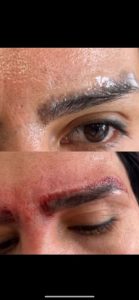 احمدی ریموو تاتو کربوکسی صورت لیزر موهای زائد در ستارخان