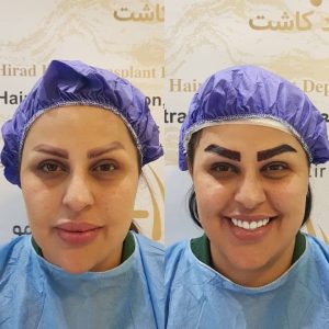 کاشت مو هیرادکاشت کاشت مو ابرو ریش در پاسداران