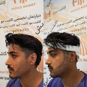 کاشت مو هیرادکاشت کاشت مو ابرو ریش در پاسداران 11
