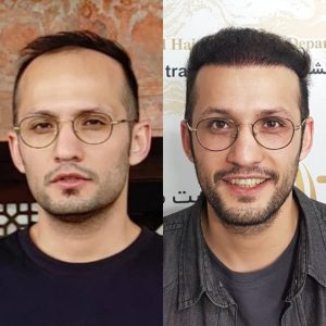 کاشت مو هیرادکاشت کاشت مو ابرو ریش در پاسداران 3
