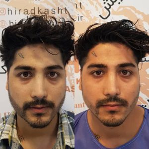 کاشت مو هیرادکاشت کاشت مو ابرو ریش در پاسداران 4