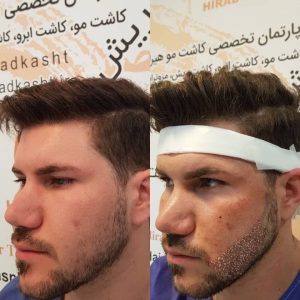 کاشت مو هیرادکاشت کاشت مو ابرو ریش در پاسداران 5