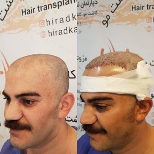 کاشت مو هیرادکاشت کاشت مو ابرو ریش در پاسداران 6
