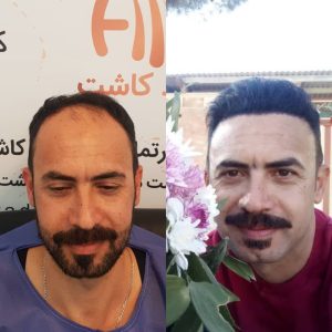 کاشت مو هیرادکاشت کاشت مو ابرو ریش در پاسداران 7