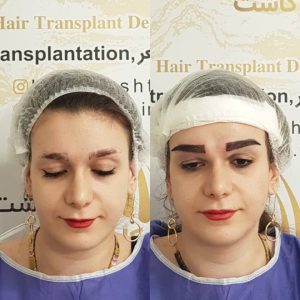 کاشت مو هیرادکاشت کاشت مو ابرو ریش در پاسداران 9