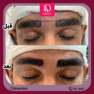 کلینیک ‏زیبایی ‏دیناز ‏خدمات ‏کاشت ‏مو ‏و ‏کاشت ‏ابرو ‏و ‏بلفاروپلاستی ‏در ‏تهران ‏سعادت ‏آباد