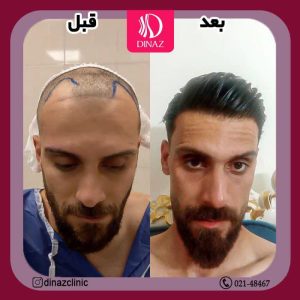 کلینیک ‏زیبایی ‏دیناز ‏خدمات ‏کاشت ‏مو ‏و ‏کاشت ‏ابرو ‏و ‏بلفاروپلاستی ‏در ‏تهران ‏سعادت ‏آباد