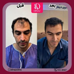 کلینیک ‏زیبایی ‏دیناز ‏خدمات ‏کاشت ‏مو ‏و ‏کاشت ‏ابرو ‏و ‏بلفاروپلاستی ‏در ‏تهران ‏سعادت ‏آباد