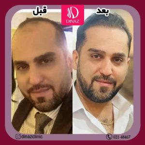 کلینیک ‏زیبایی ‏دیناز ‏خدمات ‏کاشت ‏مو ‏و ‏کاشت ‏ابرو ‏و ‏بلفاروپلاستی ‏در ‏تهران ‏سعادت ‏آباد