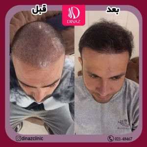 کلینیک ‏زیبایی ‏دیناز ‏خدمات ‏کاشت ‏مو ‏و ‏کاشت ‏ابرو ‏و ‏بلفاروپلاستی ‏در ‏تهران ‏سعادت ‏آباد