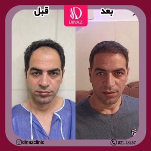کلینیک ‏زیبایی ‏دیناز ‏خدمات ‏کاشت ‏مو ‏و ‏کاشت ‏ابرو ‏و ‏بلفاروپلاستی ‏در ‏تهران ‏سعادت ‏آباد