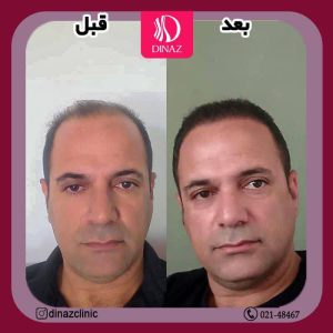 کلینیک ‏زیبایی ‏دیناز ‏خدمات ‏کاشت ‏مو ‏و ‏کاشت ‏ابرو ‏و ‏بلفاروپلاستی ‏در ‏تهران ‏سعادت ‏آباد