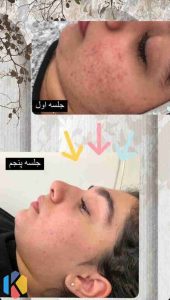 ‏سالن ‏زیبایی ‏مرکاتو ‏فیشال ‏پاکسازی ‏پوست ‏اسیدتراپی ‏در ‏شمس ‏آباد ‏هروی