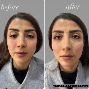 بیوتی لند تزریق چربی ژل بوتاکس لیزر موهای زائد تخلیه چربی در تهران پاسداران 4 2 1 1 1 1