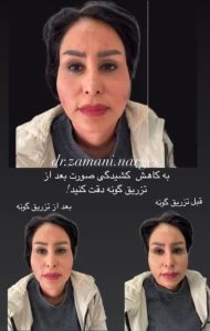 بیوتی لند تزریق چربی ژل بوتاکس لیزر موهای زائد تخلیه چربی در تهران پاسداران 6 2 1 1 1 1