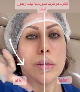 بیوتی لند تزریق چربی ژل بوتاکس لیزر موهای زائد تخلیه چربی در تهران پاسداران 9 2 1 1 1 1