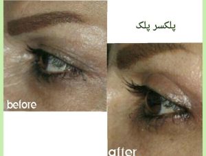 ‏فهیمه ‏درفشی ‏خدمات ‏هایفوتراپی ‏‏لیفت ‏نخ ‏اندولیفت ‏در ‏تهران میرداماد 6