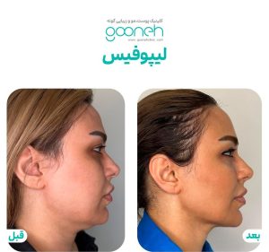 ‏گونه ‏بلفاروپلاستی ‏لیپوفیس ‏بوکال ‏فت ‏در ‏تهران ‏جردن 10