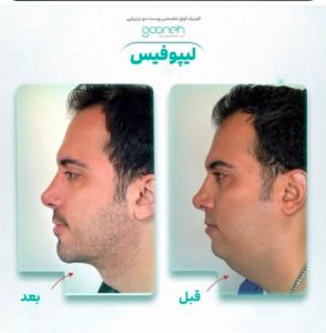 ‏گونه ‏بلفاروپلاستی ‏لیپوفیس ‏بوکال ‏فت ‏در ‏تهران ‏جردن 11