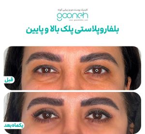 ‏گونه ‏بلفاروپلاستی ‏لیپوفیس ‏بوکال ‏فت ‏در ‏تهران ‏جردن 12