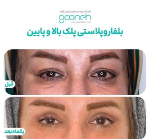 ‏گونه ‏بلفاروپلاستی ‏لیپوفیس ‏بوکال ‏فت ‏در ‏تهران ‏جردن 13
