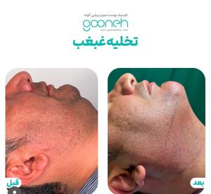 ‏گونه ‏بلفاروپلاستی ‏لیپوفیس ‏بوکال ‏فت ‏در ‏تهران ‏جردن 2