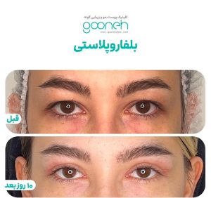 ‏گونه ‏بلفاروپلاستی ‏لیپوفیس ‏بوکال ‏فت ‏در ‏تهران ‏جردن 3