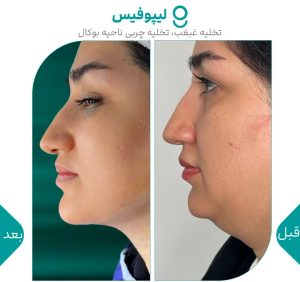 ‏گونه ‏بلفاروپلاستی ‏لیپوفیس ‏بوکال ‏فت ‏در ‏تهران ‏جردن