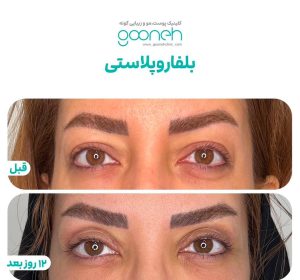 ‏گونه ‏بلفاروپلاستی ‏لیپوفیس ‏بوکال ‏فت ‏در ‏تهران ‏جردن 4