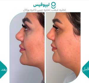 ‏گونه ‏بلفاروپلاستی ‏لیپوفیس ‏بوکال ‏فت ‏در ‏تهران ‏جردن 5