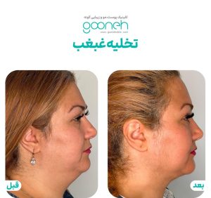 ‏گونه ‏بلفاروپلاستی ‏لیپوفیس ‏بوکال ‏فت ‏در ‏تهران ‏جردن 6