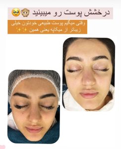 فارسیجانی فیشال پاکسازی جوانسازی پوست در عظیمیه کرج 4