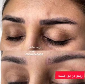 زیبایی و میکرو پریسا صالحی فیبروز میکرو لب و چشم ابرو ریمو ابرو در فلاح 15