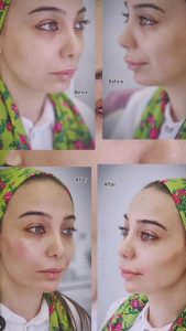 درنیکا لیزر و فیلر و هایفو در خیابان بهشتی کرج 15
