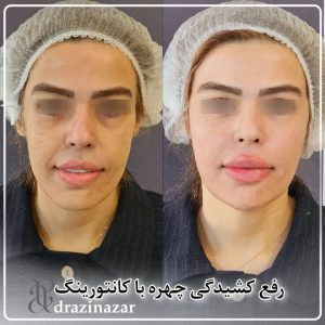 dr azin 4