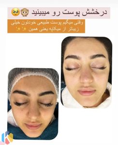 فارسیجانی فیشال پاکسازی جوانسازی پوست در عظیمیه کرج 4 result 834x1024 result