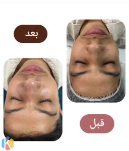 فارسیجانی فیشال پاکسازی جوانسازی پوست در عظیمیه کرج 9 result 873x1024 result