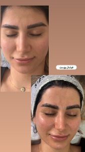 زیبایی مرکاتو فیشال پاکسازی پوست اسیدتراپی در شمس آباد هروی