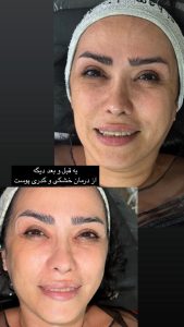 زیبایی مرکاتو فیشال پاکسازی پوست اسیدتراپی در شمس آباد هروی 13