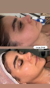 زیبایی مرکاتو فیشال پاکسازی پوست اسیدتراپی در شمس آباد هروی 6