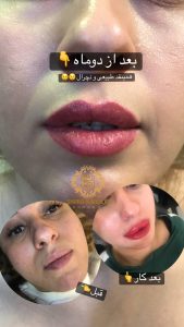 ‏شیما ‏خادمی ‏فیبروز ‏ابرو ‏و ‏تاتو ‏بدن ‏میکروبلیدینگ ‏در ‏ستارخان 19