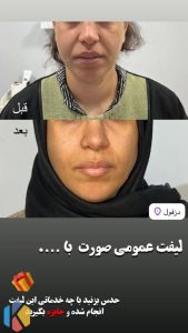 زیبایی اولند تزریق بوتاکس و ژل و لیزر موهای زائد در دزفول 2 576x1024 result