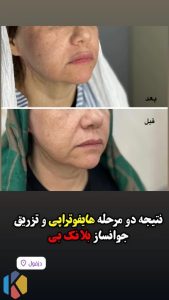 زیبایی اولند تزریق بوتاکس و ژل و لیزر موهای زائد در دزفول 3 576x1024 result