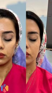 زیبایی اولند تزریق بوتاکس و ژل و لیزر موهای زائد در دزفول 5 574x1024 result