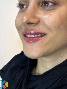 زیبایی اولند تزریق بوتاکس و ژل و لیزر موهای زائد در دزفول 9 768x1024 result