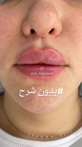 زیبایی دالیا خدمات لیزر و فیلر لب و فیشال در پیروزی 2