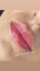 زیبایی دالیا خدمات لیزر و فیلر لب و فیشال در پیروزی 4