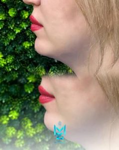 ‏زیبایی ‏مینورا ‏کلینیک ‏مجهز ‏به ‏دستگاه ‏لاغری ‏کوتیشن ‏آرف ‏کریو ‏تخصصی ‏غبغب ‏در ‏شهرک ‏گلستان ‏بام ‏لند 18