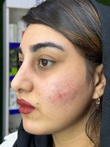 دکتر دهقان تزریق ژل بوتاکس لیزر موهای زائد تاتو و لک در ملارد مارلیک 2