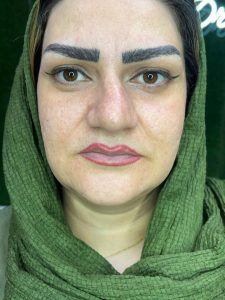 دکتر دهقان تزریق ژل بوتاکس لیزر موهای زائد تاتو و لک در ملارد مارلیک